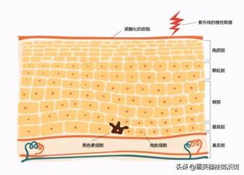 黄褐斑的形成原因及预防措施