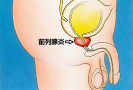 前列腺炎：症状、中成药治疗及预防措施