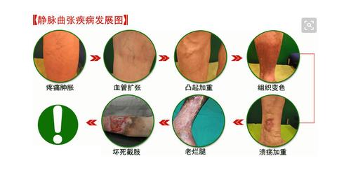 阴囊湿疹的治疗方法：中药西药双管齐下，日常护理不可少