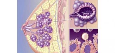 乳腺小叶增生的症状：了解病变与疼痛