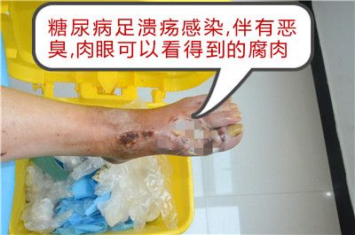 糖尿病足病，症状、治疗与预防全攻略