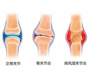 骨折并发症：关节僵硬、生长障碍与创伤性关节炎的预防与治疗