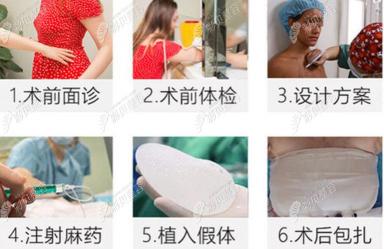 假体丰胸方法：手术方式、优点及注意事项全解析