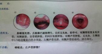 声带息肉：成因、症状与影响，全面解析！