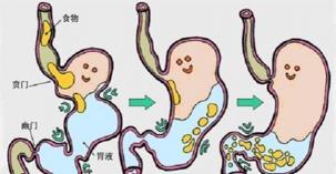 胆汁反流性胃炎的治疗与调理：从西药到中药，全方位解析