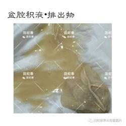 盆腔积液：原因、影响与防治指南