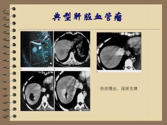 肝脏血管瘤治疗方法大揭秘