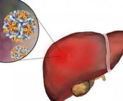 肝硬化中期能治好吗？专家解析治疗方法与预后
