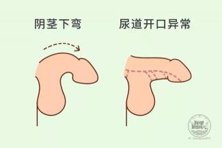 割包皮的潜在风险与坏处：手术前必知