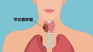 甲状腺癌症状：呼吸困难、乳头状肿块与滤泡状癌的警示