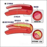 颈动脉粥样硬化：了解、预防与治疗的关键