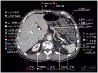 CT能检查出什么？揭秘腹部CT的全方位诊断能力