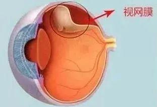 揭秘视网膜脱落：原因、症状与防治措施