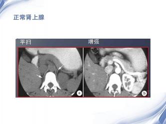 肾上腺肿瘤：成因、预防与认识