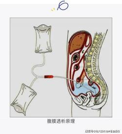 透析：清除体内毒素的关键治疗手段