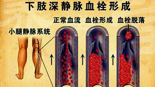 陈旧的血栓怎样溶解？专业解析陈旧性血栓的治疗与自溶机制