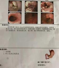 胃癌：由哪些原因引起的？