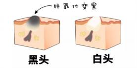 去黑头的最好方法：从基础清洁到专业治疗