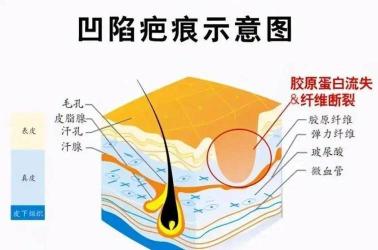 凹陷性疤痕的治疗：多种方法助您恢复皮肤健康