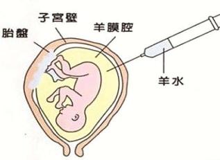 羊水穿刺：孕期的重要检查与胎儿健康的守护者