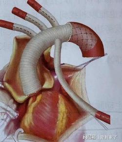 漏斗胸的原因：科学解析与家族遗传的影响