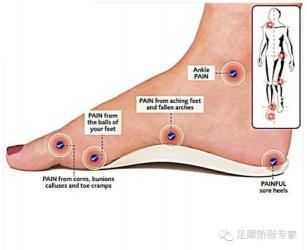 脚丫子疼？可能是扁平足、足底筋膜炎或跟骨高压症在作祟