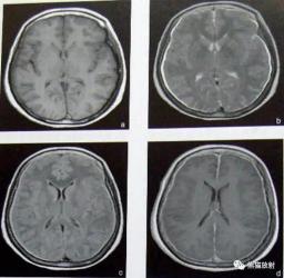 化脓性脑炎：认识、症状与应对方法