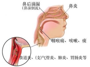 老是咳嗽怎么办？全面指南帮你解决咳嗽困扰