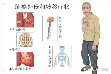 肺癌肝转移的症状及防治：了解症状，及时治疗