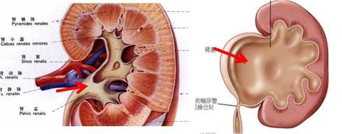 肾积水：严重威胁肾脏健康的潜在隐患