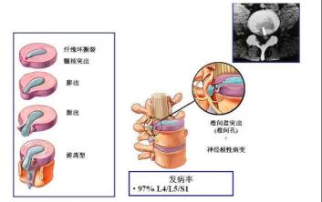 腰椎间盘膨出：了解原因与治疗方法，守护您的腰部健康