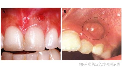 牙齿瘘管揭秘：成因、治疗与日常护理全解析