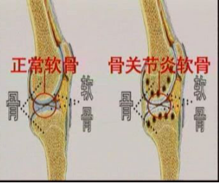 膝关节退行性关节炎：症状识别与日常防范