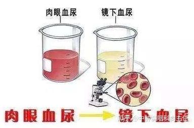 膀胱癌症状大揭秘：尿频、尿急、血尿等不可忽视