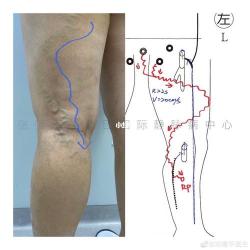 静脉曲张中医分型治疗全解析