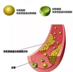 坏胆固醇揭秘：低密度脂蛋白偏高是什么意思？