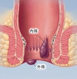 肛门小疙瘩揭秘：成因、预防与应对策略