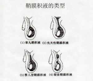 睾丸鞘膜积液的治疗：中医、注射、自我痊愈与手术，哪种方法最适合你？