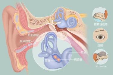 耳石病”揭秘：眩晕背后的“石头”真相