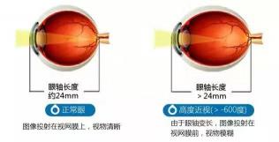 近视眼可以治疗嘛？探索假性近视的有效治疗方法