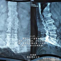 骨质增生的症状详解：如何识别与应对？