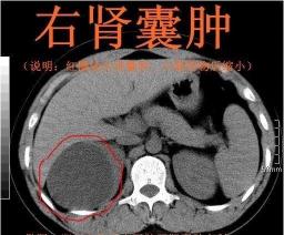 肾囊肿能治好吗？专家解析：肾囊肿的治愈希望及科学治疗方法