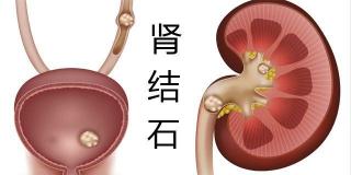 肾部疼痛的原因揭秘：感染、结石与囊肿，及早诊断治疗是关键！