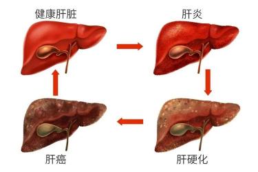 感染乙肝的症状有哪些？一文详解乙肝感染后的典型表现