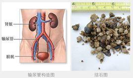 肾结石怎么治疗？专家解析不同大小结石的最佳治疗方案