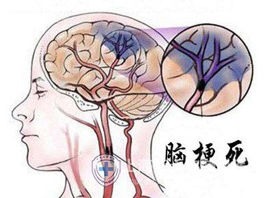 多发性脑梗塞：全面了解其治疗策略与应对方法