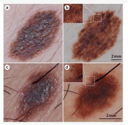 如何分辨黑色素瘤和普通痣？五大关键差异助你识别！