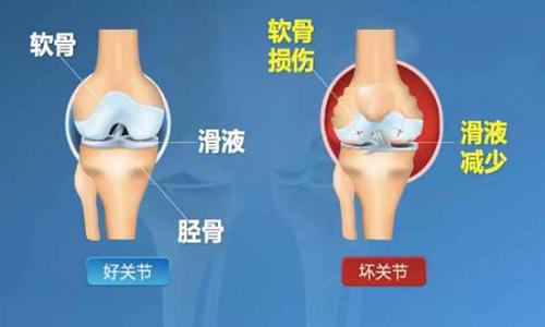 骨质增生：从治疗到预防，全方位解析骨质问题