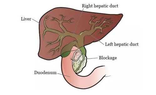 CCAV是什么？胆囊癌患者必知的黄疸类型与治疗方法