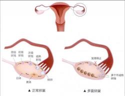 多囊卵巢综合症原因揭秘：精神因素、孕期激素变化与肾上腺功能异常等关键因素解析